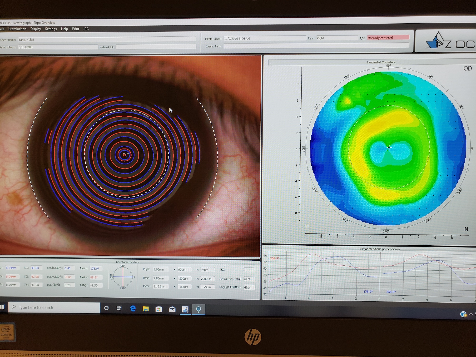 Photo of an Ortho-k image